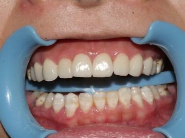 Traitement dyschromies dentaires à Bagnolet